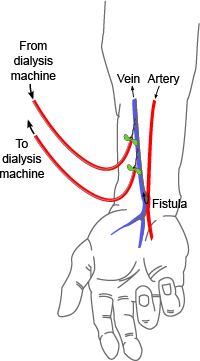 Radiocephalic fistula - vascular studies