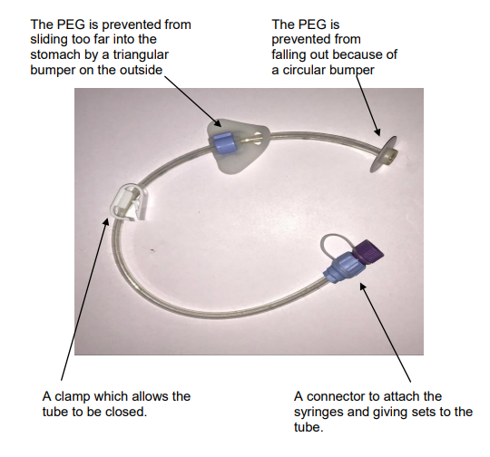 Looking after your Percutaneous Endoscopic Gastrostomy tube (PEG) CUH