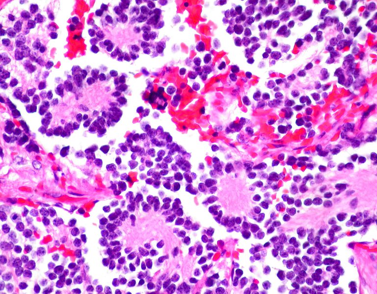 Neuroblastoma