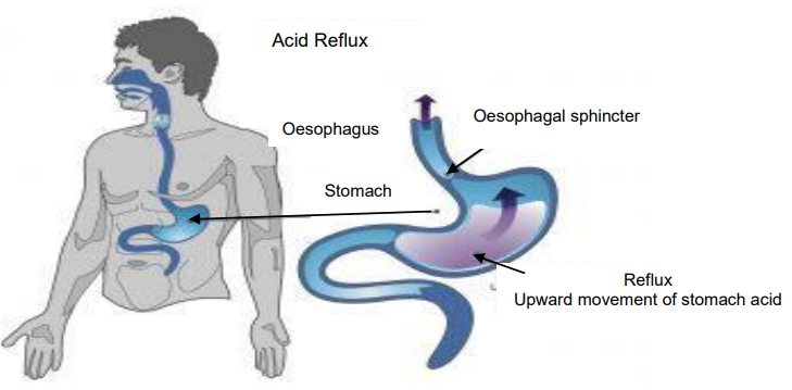 Dietary And Lifestyle Advice For Adults With Gastro oesophageal Reflux 